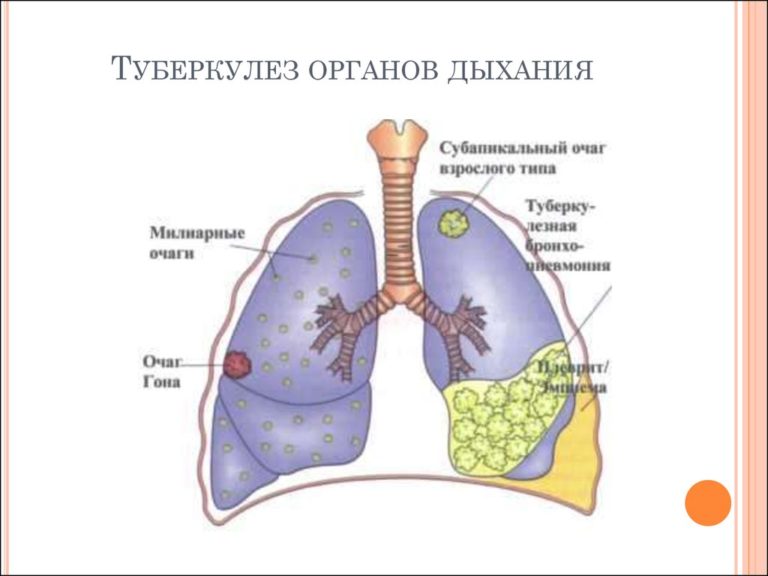 Профилактика туберкулеза